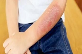 ITEM 10 – BRÛLURES CUTANÉES RÉCENTES