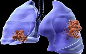 ITEM 11 – CANCER BRONCHO PULMONAIRE