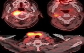 ITEM 12 – CANCERS DU CAVUM