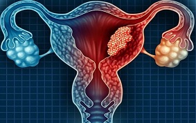 ITEM 13 – CANCER DU COL DE L’UTERUS