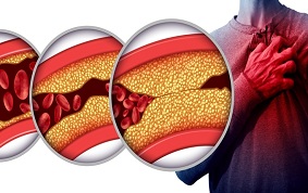 ITEM 23 – DYSLIPIDÉMIES