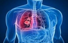 ITEM 09 – BRONCHOPNEUMOPATHIES CHRONIQUES OBSTRUCTIVES