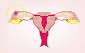 ITEM 32 – GROSSESSE EXTRA-UTÉRINE