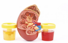 ITEM 33 – HEMATURIES