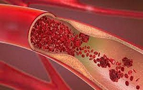 ITEM 49 – ISCHÉMIE AIGUË DES MEMBRES