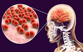 ITEM 52 – MÉNINGITESBACTERIENNES ET VIRALES