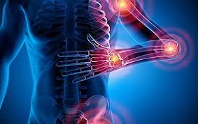 ITEM 58 – POLYARTHRITES RHUMATOÏDES