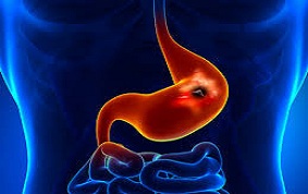 ITEM 74 – ULCÈRES GASTRIQUES ET DUODÉNAUX